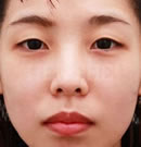 雙眼皮整形前后對(duì)比照片