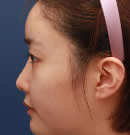 Two-Line鼻整形手術(shù)前后對(duì)比照片