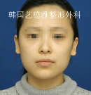 兩顎手術(shù)