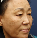 移植除皺手術(shù)對比案例