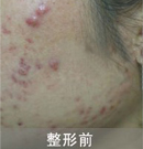 激光祛痘對比案例