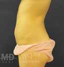 腹部吸脂手術(shù)前后對比照片