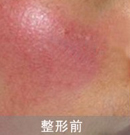 激光去紅血絲對比案例