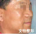 筋膜懸吊術(shù)對比案例
