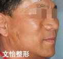 筋膜懸吊術(shù)對比案例