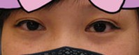 那一天，終于鼓足勇氣割了雙眼皮