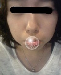 吸脂瘦臉后 包子臉變成了錐子臉~~~