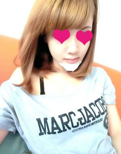 第二天的、、之后就沒怎么照咯。我恢復(fù)的是超級快耶。自己都不敢相信、

之前總覺得臉不夠立體，較終還是墊了下巴，不過很保守不敢做太尖，就墊長了一點(diǎn)點(diǎn)。做了之后比較一下臉還是比之前長一點(diǎn)了，也顯老一些。不過還是挺滿意的!
下面是下巴完全恢復(fù)的時候照的。。
