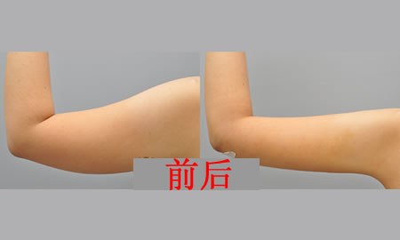 吸脂手術(shù)，一起來看看她的大家愛分享的手術(shù)過程