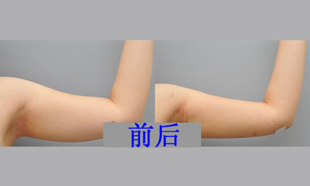 手臂吸脂很詳細(xì)的恢復(fù)過程，有興趣的可以看看撒~~~