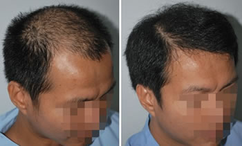 兩次植發(fā)后的成果，持續(xù)更新中