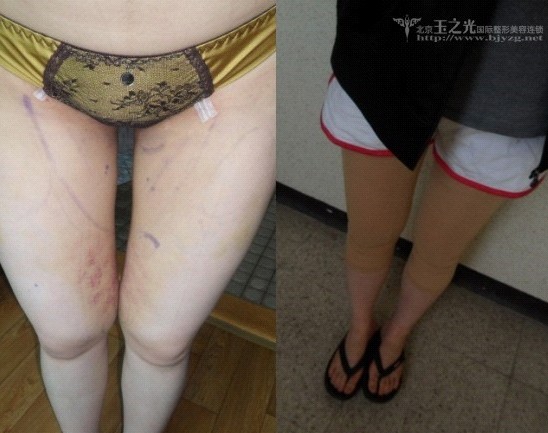 大腿吸脂全程記錄，個人經(jīng)驗貼哦