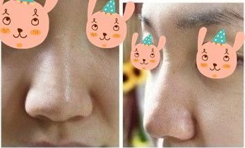 【隆鼻】美鼻秀起來(lái)O(∩_∩)O~！