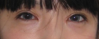 做完雙眼皮加開眼角一個多月后眼角有點疤痕增生，不過幸好的是黃色已經(jīng)消退