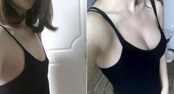 自體脂肪隆胸后我輕松駕馭各種性感小禮服