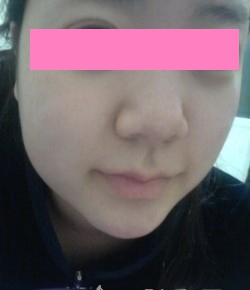面部吸脂我擺脫了嘟嘟大臉，做了瓜子女神啦