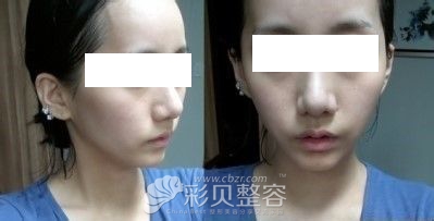 我做了全面部脂肪填充，歡迎大家圍觀
