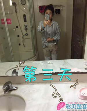 大腿吸脂后我終于擺脫了大象腿