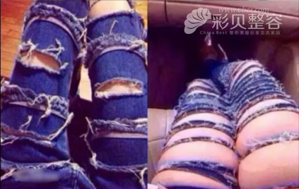 腿部吸脂