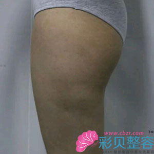 大腿吸脂收獲一雙又直又細的美腿~