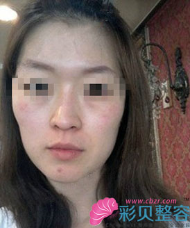 脂肪填充后面部再也不干干癟癟了