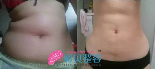 腹部吸脂術(shù)后，穿什么都百搭O(∩_∩)O~~