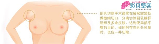 副乳切除自有妙招 讓胸部不再煩惱