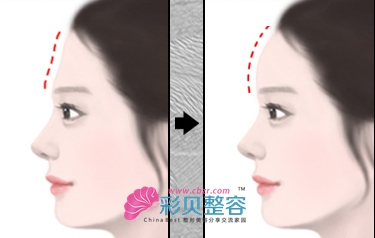 請(qǐng)聽(tīng)講：豐額頭術(shù)的兩大絕招