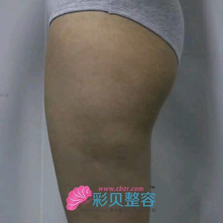 大腿吸脂讓我終于瘦下來了O(∩_∩)O~~