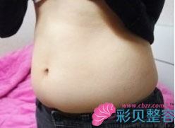 大腿和腹部吸脂 實現(xiàn)了我的苗條夢