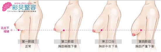 胸部下垂程度
