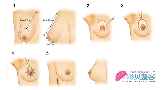 乳房懸吊術(shù)