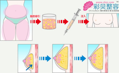 豐胸持續(xù)時間