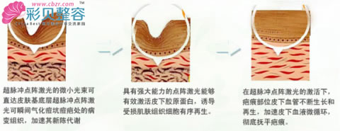去疤原理