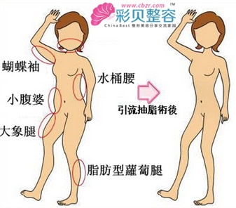 吸脂原理