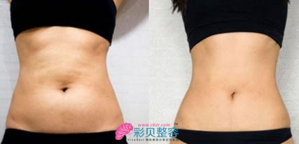 腰腹吸脂前后對(duì)比圖