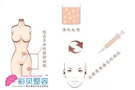 面部脂肪移植