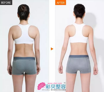 溶脂減肥對比案例