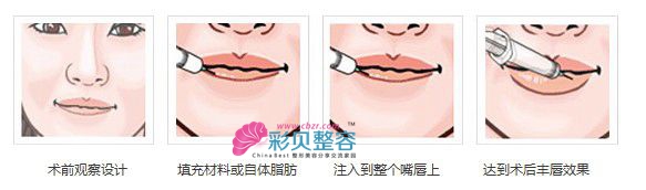 玻尿酸豐唇原理圖
