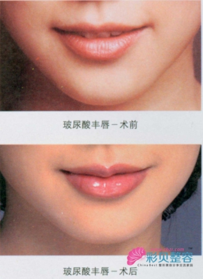 玻尿酸豐唇前后對比圖