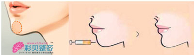 注射填充下巴示意圖