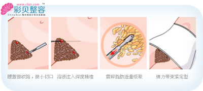 吸脂過(guò)程