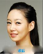 簡(jiǎn)單的吸脂瘦臉就能讓人變美