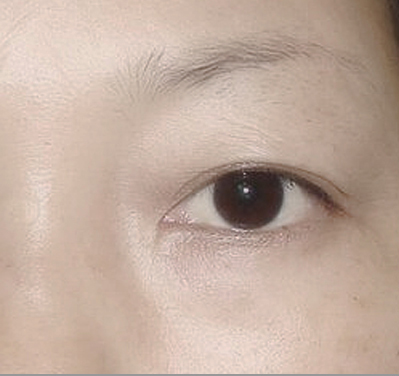 深圳南西子醫(yī)療美容案例 紋眉