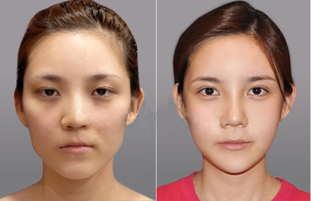 深圳南西子醫(yī)療美容門診部 雙眼皮修復(fù)案例
