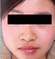 彩光嫩膚手術(shù)案例