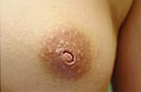 乳頭內(nèi)陷手術(shù)案例