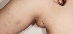 副乳整形術(shù)案例