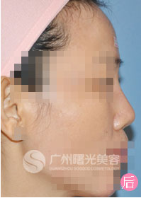 注射隆鼻案例