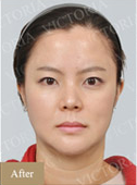 瘦臉除皺瘦臉案例